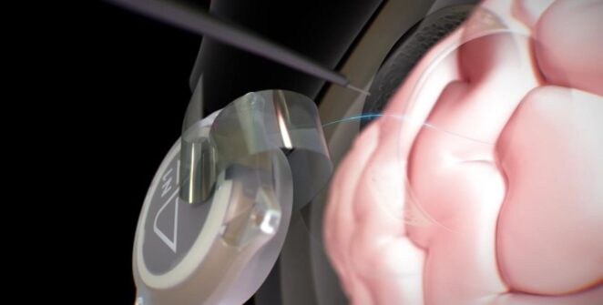 TECH NEWS – During the interview, we learned that twelve of their patients have used the brain-computer interface (BCI) for nearly six years combined.