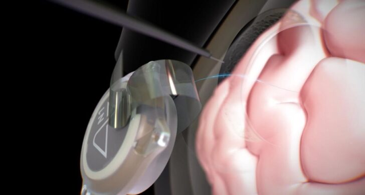 TECH NEWS – During the interview, we learned that twelve of their patients have used the brain-computer interface (BCI) for nearly six years combined.